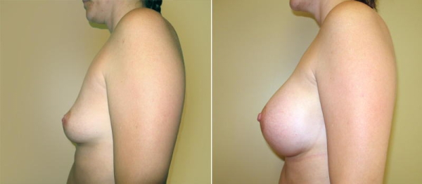 豊胸手術のビフォーアフター画像!やっぱり違和感あるなw 118 豊胸手術のビフォーアフター画像!やっぱり違和感あるなw 117 img 693940dadb9d4