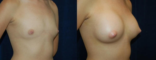 豊胸手術のビフォーアフター画像!やっぱり違和感あるなw 120 豊胸手術のビフォーアフター画像!やっぱり違和感あるなw 119 img 693940daf33f9