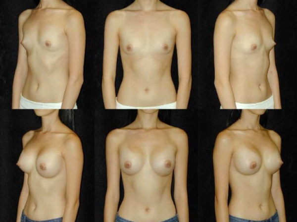 豊胸手術のビフォーアフター画像!やっぱり違和感あるなw 126 豊胸手術のビフォーアフター画像!やっぱり違和感あるなw 125 img 693940db47ac5