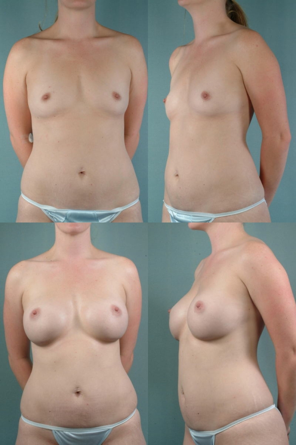 豊胸手術のビフォーアフター画像!やっぱり違和感あるなw 130 豊胸手術のビフォーアフター画像!やっぱり違和感あるなw 129 img 693940db73a1a