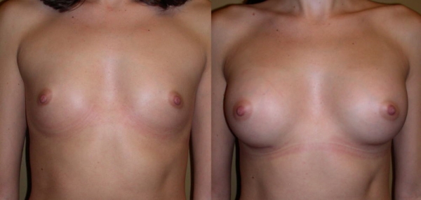 豊胸手術のビフォーアフター画像!やっぱり違和感あるなw 136 豊胸手術のビフォーアフター画像!やっぱり違和感あるなw 135 img 693940dbb59e6