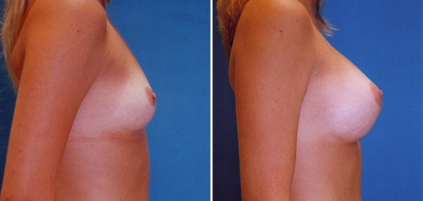 豊胸手術のビフォーアフター画像!やっぱり違和感あるなw 138 豊胸手術のビフォーアフター画像!やっぱり違和感あるなw 137 img 693940dbc4a8c