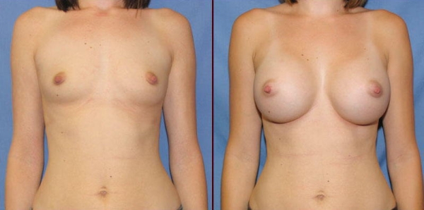 豊胸手術のビフォーアフター画像!やっぱり違和感あるなw 140 豊胸手術のビフォーアフター画像!やっぱり違和感あるなw 139 img 693940dbd2995