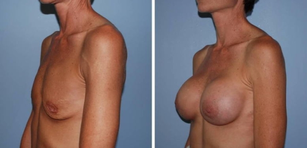 豊胸手術のビフォーアフター画像!やっぱり違和感あるなw 144 豊胸手術のビフォーアフター画像!やっぱり違和感あるなw 143 img 693940dbf2114