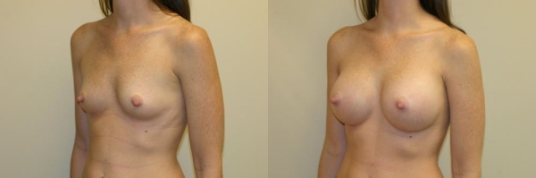 豊胸手術のビフォーアフター画像!やっぱり違和感あるなw 146 豊胸手術のビフォーアフター画像!やっぱり違和感あるなw 145 img 693940dc16255