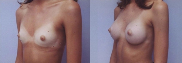 豊胸手術のビフォーアフター画像!やっぱり違和感あるなw 148 豊胸手術のビフォーアフター画像!やっぱり違和感あるなw 147 img 693940dc5bde2