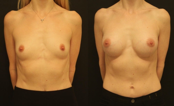 豊胸手術のビフォーアフター画像!やっぱり違和感あるなw 150 豊胸手術のビフォーアフター画像!やっぱり違和感あるなw 149 img 693940dc6eb01