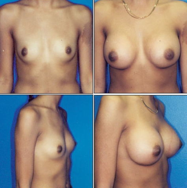 豊胸手術のビフォーアフター画像!やっぱり違和感あるなw 154 豊胸手術のビフォーアフター画像!やっぱり違和感あるなw 153 img 693940dc8de2c