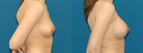 豊胸手術のビフォーアフター画像!やっぱり違和感あるなw 156 豊胸手術のビフォーアフター画像!やっぱり違和感あるなw 155 img 693940dc9c90c