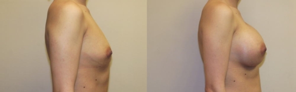 豊胸手術のビフォーアフター画像!やっぱり違和感あるなw 162 豊胸手術のビフォーアフター画像!やっぱり違和感あるなw 161 img 693940dcd4c52