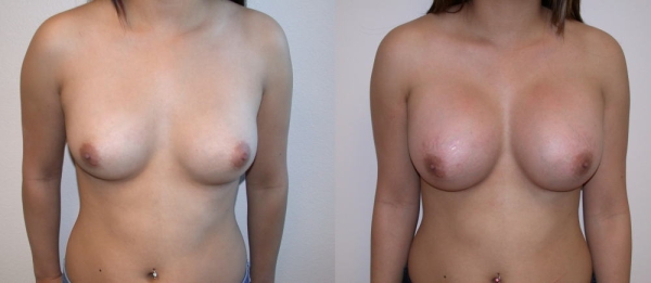 豊胸手術のビフォーアフター画像!やっぱり違和感あるなw 166 豊胸手術のビフォーアフター画像!やっぱり違和感あるなw 165 img 693940dd01a13