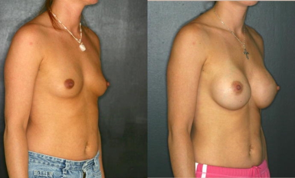 豊胸手術のビフォーアフター画像!やっぱり違和感あるなw 168 豊胸手術のビフォーアフター画像!やっぱり違和感あるなw 167 img 693940dd10412