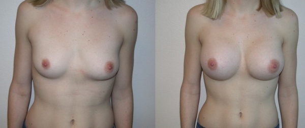 豊胸手術のビフォーアフター画像!やっぱり違和感あるなw 170 豊胸手術のビフォーアフター画像!やっぱり違和感あるなw 169 img 693940dd1ea9f